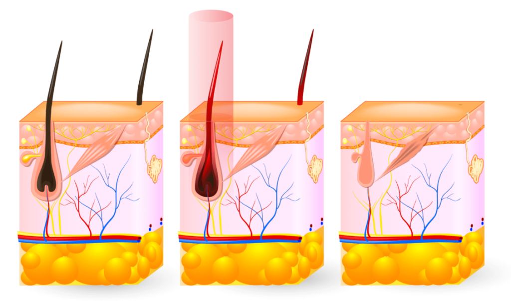 laser hair removal