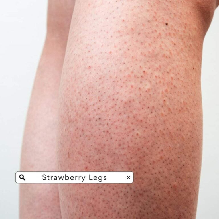 Close-up of dotted skin texture on the legs